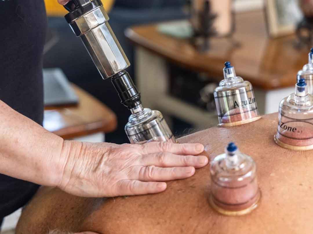 Cupping therapy